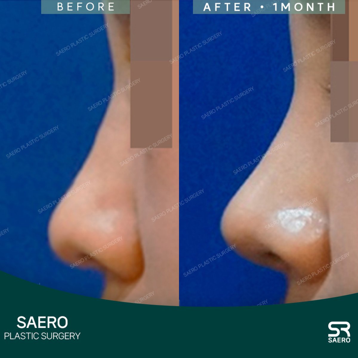 Результаты остеотомии ринопластики до и после в SAERO Plastic Surgery, улучшенный профиль носа