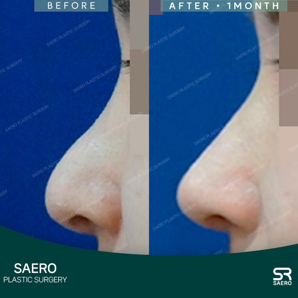 نتائج تجميل الأنف بالأوستيوتومي قبل وبعد في SAERO Plastic Surgery، تحسين شكل الأنف