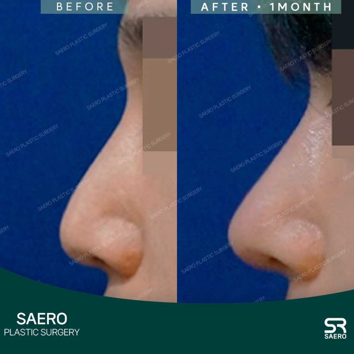 نتائج تجميل الأنف بالأوستيوتومي قبل وبعد في SAERO Plastic Surgery، تحسين شكل الأنف