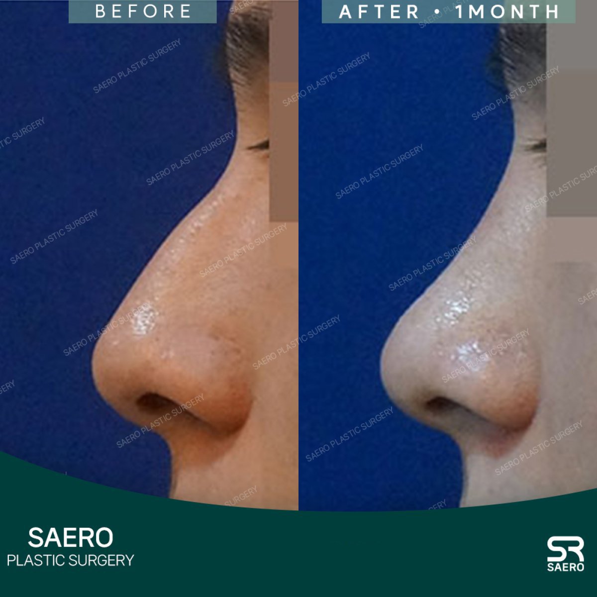 نتائج عملية تجميل الأنف بالأوستيوتومي قبل وبعد في SAERO Plastic Surgery، تحسين شكل الأنف