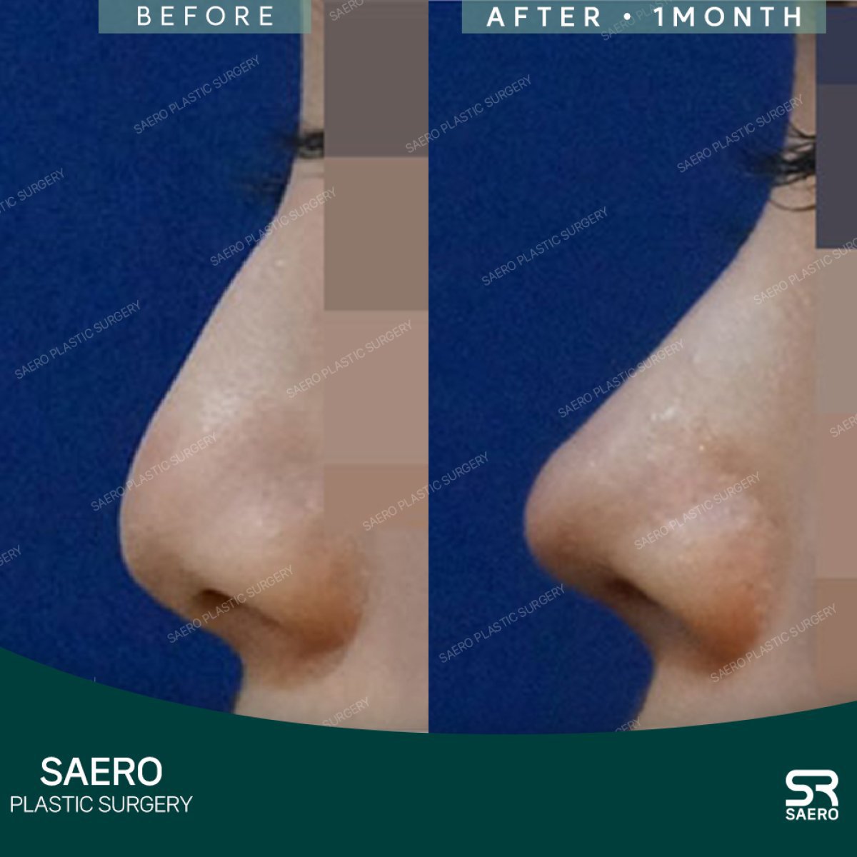 نتائج تجميل الأنف بالأوستيوتومي قبل وبعد في SAERO Plastic Surgery بعد شهر