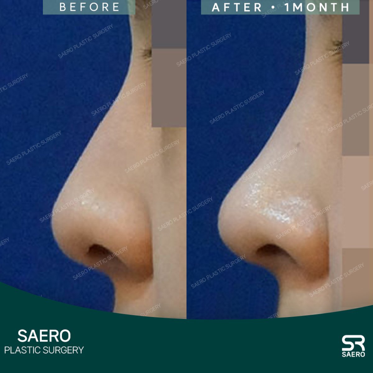 نتائج تجميل الأنف بالاستئصال قبل وبعد في SAERO Plastic Surgery، تحسين شكل الأنف