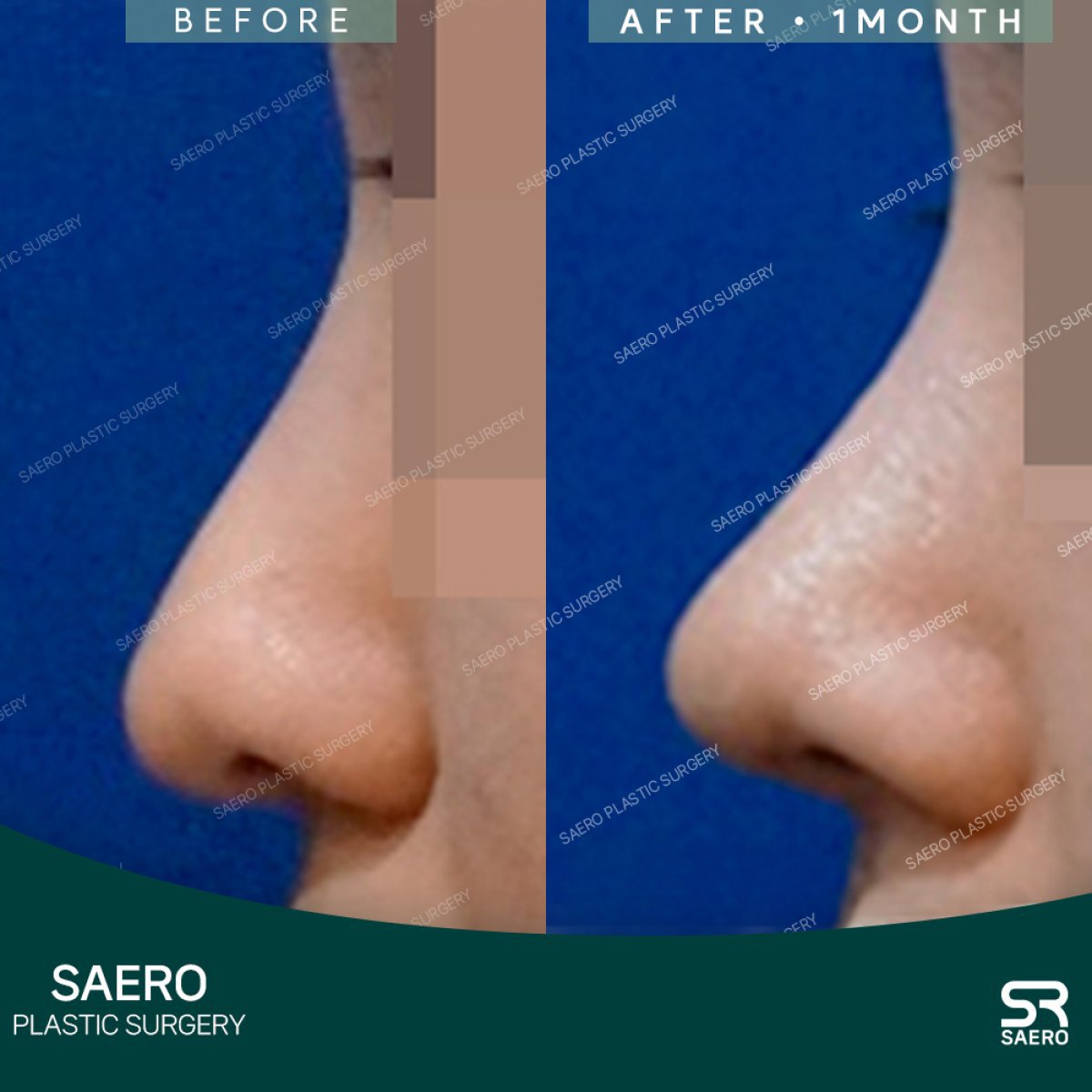 Résultats avant/après rhinoplastie par ostéotomie chez SAERO Plastic Surgery, profil du nez amélioré