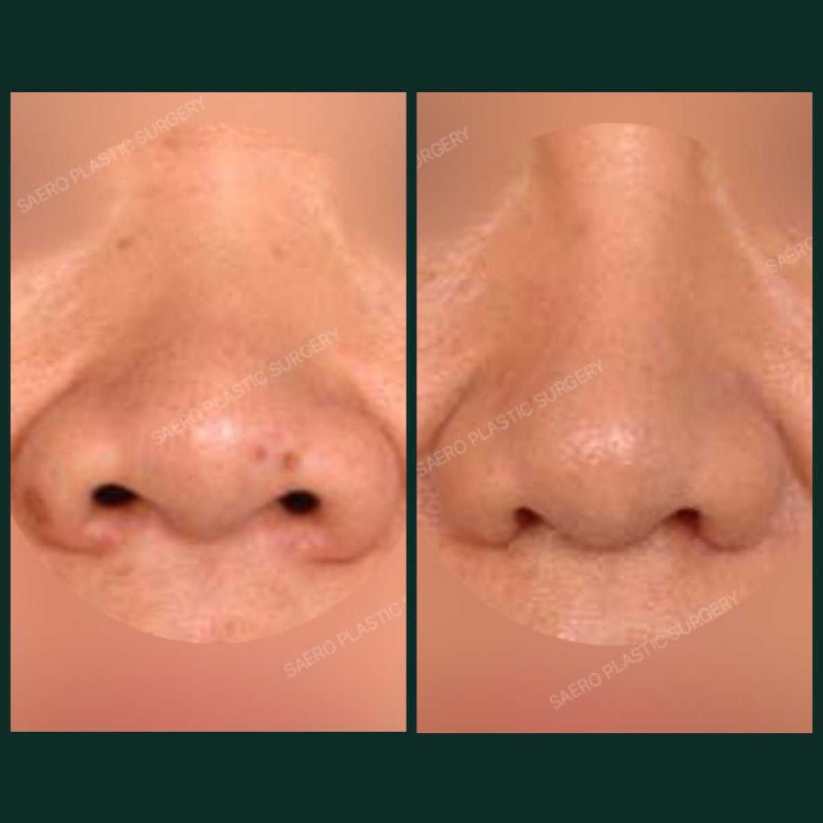 Before and after osteotomy rhinoplasty results at SAERO Plastic Surgery, improved nose shape