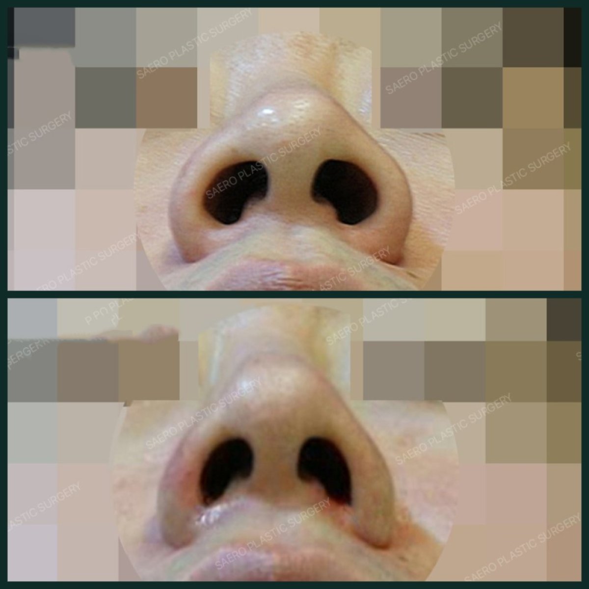 نتائج تجميل الأنف بالأوستيوتومي قبل وبعد في SAERO Plastic Surgery، تحسين شكل الأنف