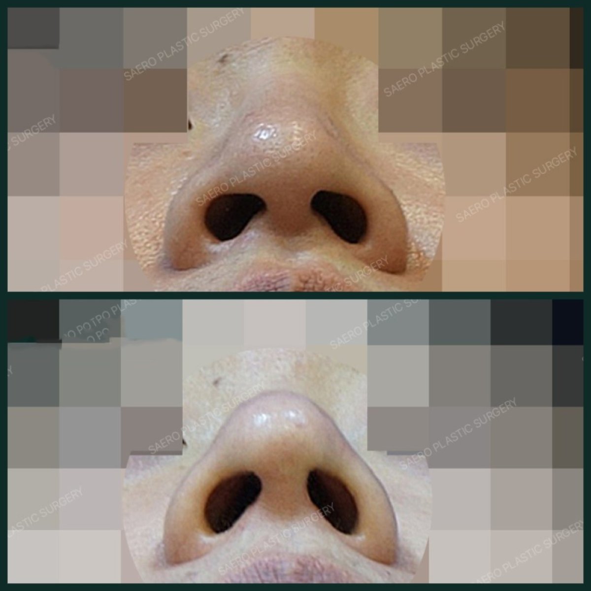 نتائج تجميل الأنف بالأوستيوتومي قبل وبعد في SAERO Plastic Surgery، تحسين شكل الأنف