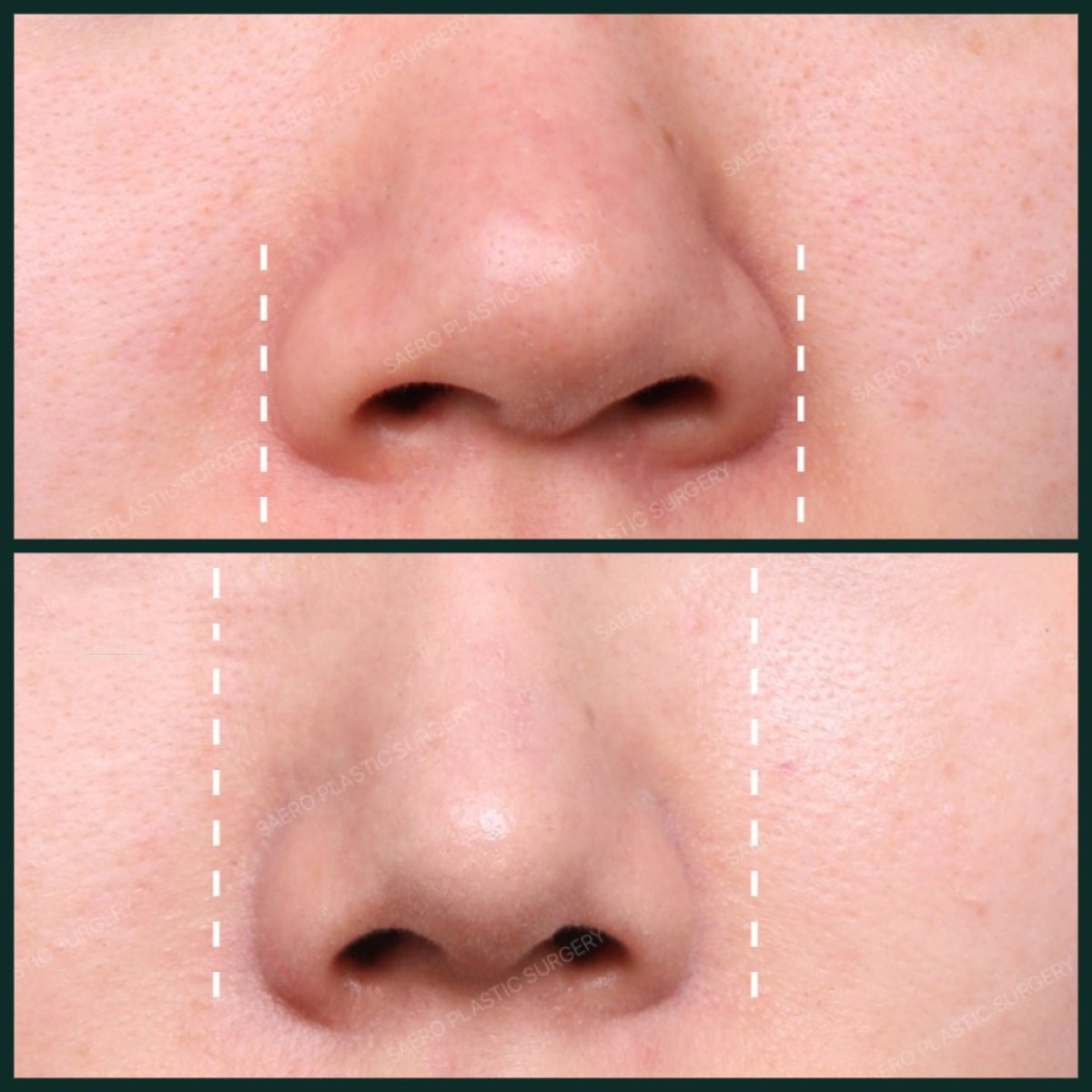Before and after osteotomy rhinoplasty results at SAERO Plastic Surgery, improved nose shape