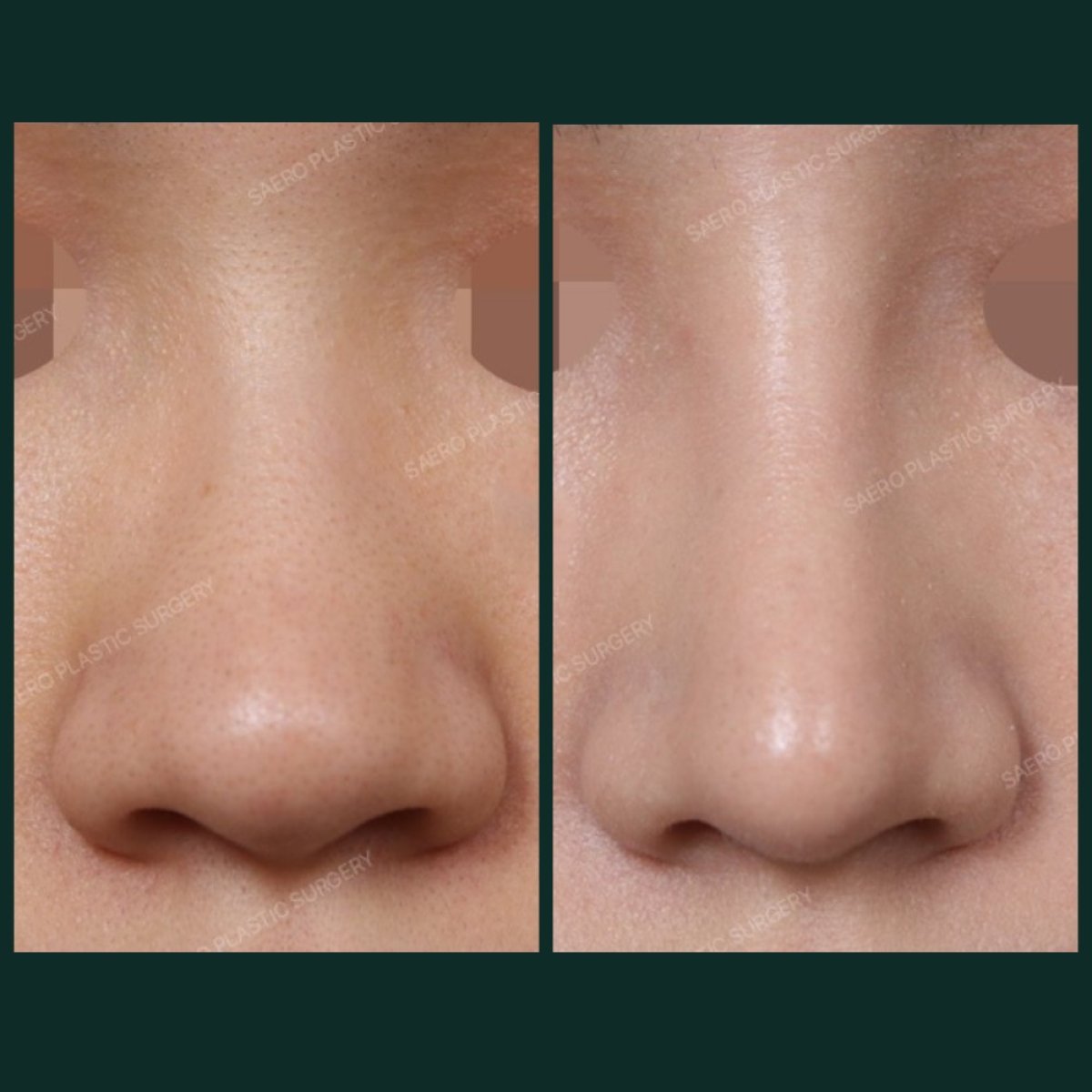 Before and after alarplasty results at SAERO Plastic Surgery, refined nostril shape improvement