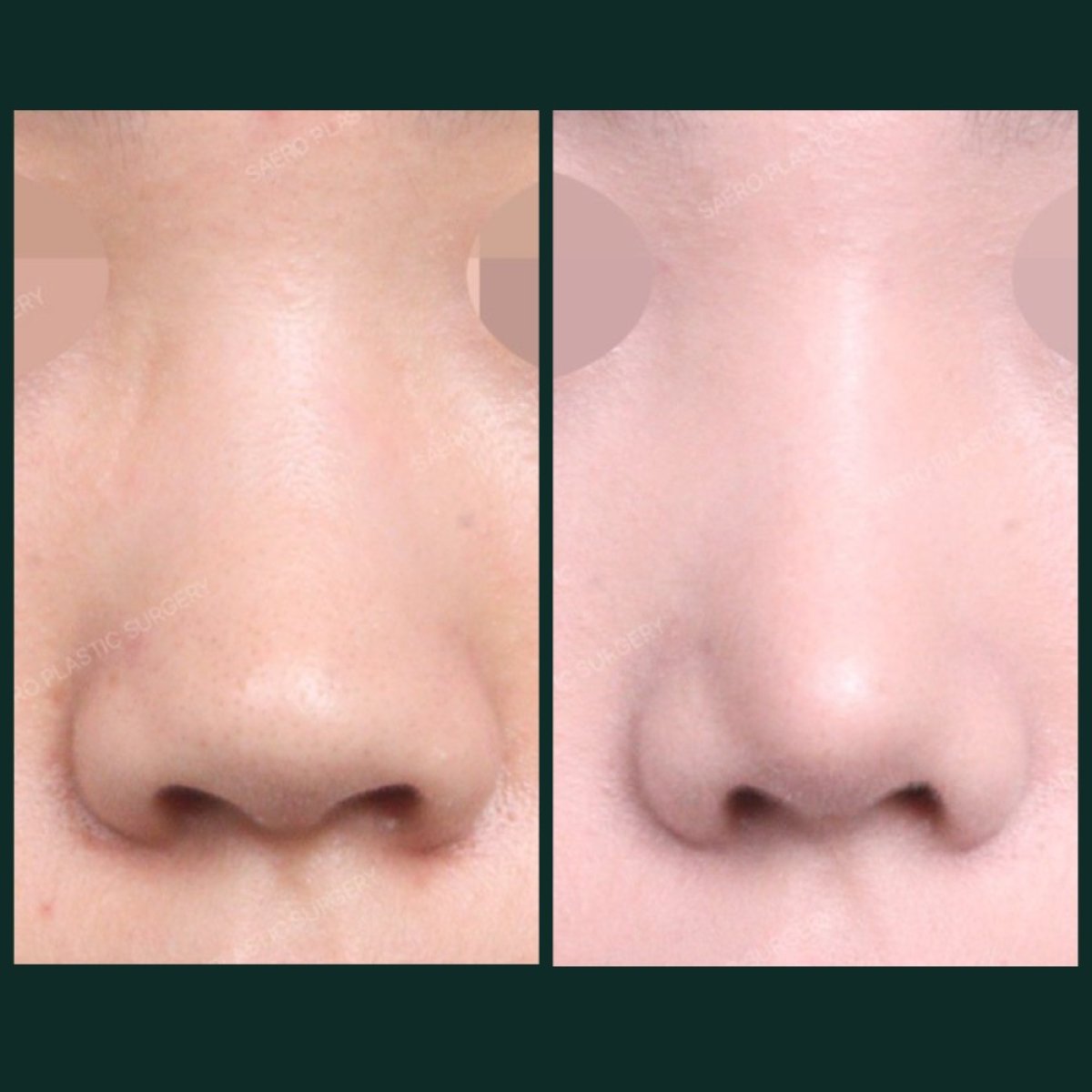 نتائج قبل وبعد عملية تصغير فتحات الأنف في SAERO Plastic Surgery، شكل فتحات أنف محسّن