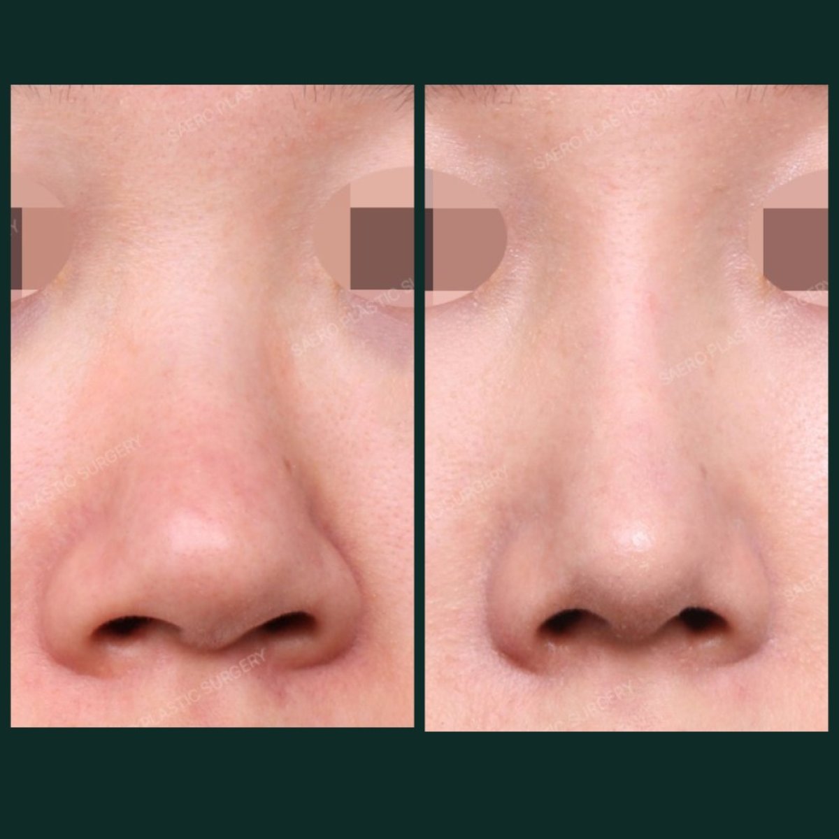 Before and after alarplasty results at SAERO Plastic Surgery, refined nostril shape improvement