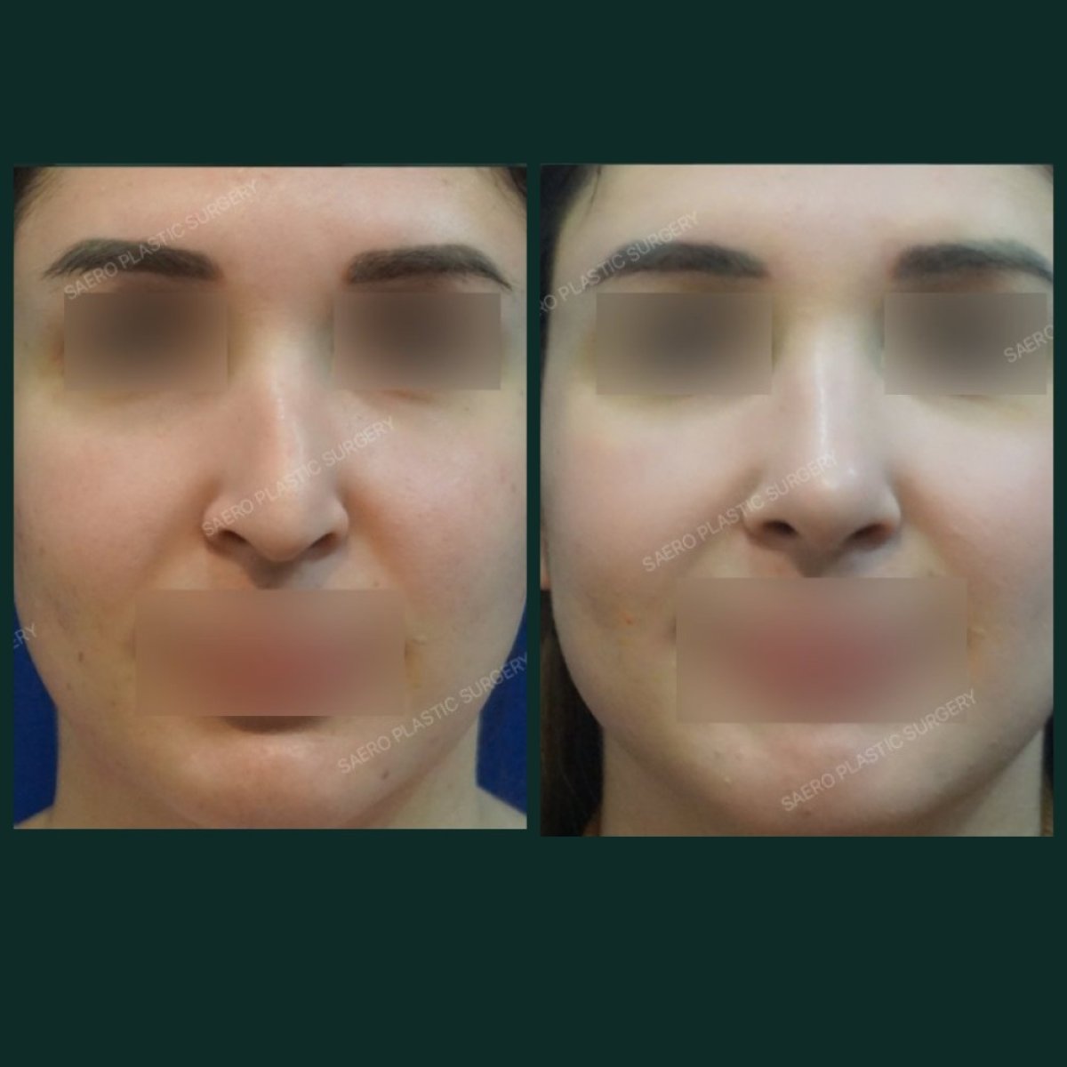 نتائج قبل وبعد عملية تصغير فتحات الأنف في SAERO Plastic Surgery، تحسين شكل الأنف