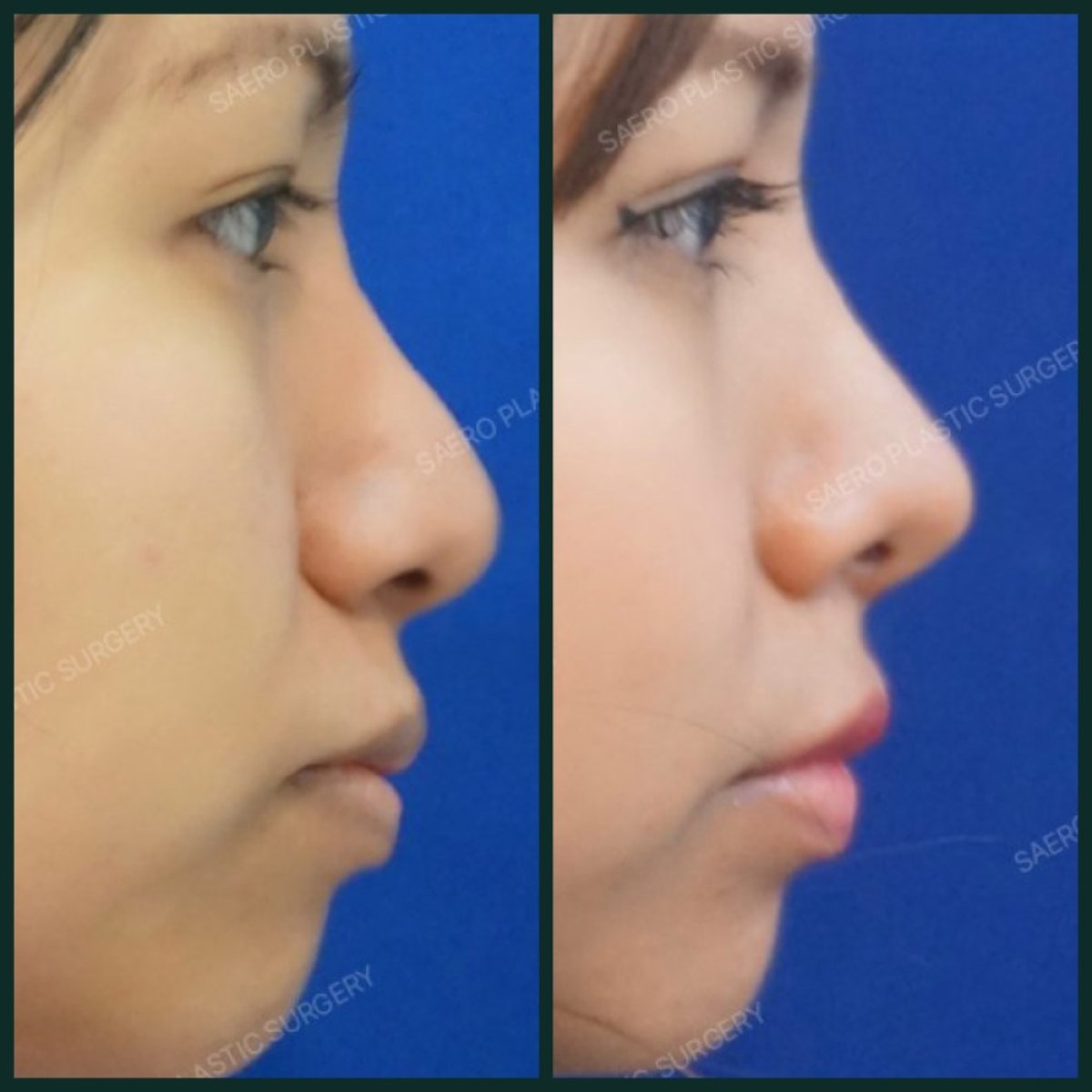 Résultats avant et après alarplastie chez SAERO Plastic Surgery, amélioration du nez