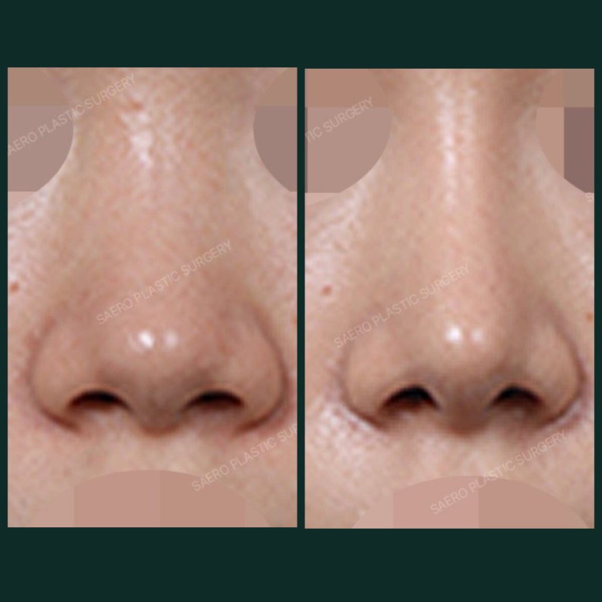 نتائج قبل وبعد عملية تصغير فتحات الأنف في SAERO Plastic Surgery وتحسين شكل الأنف