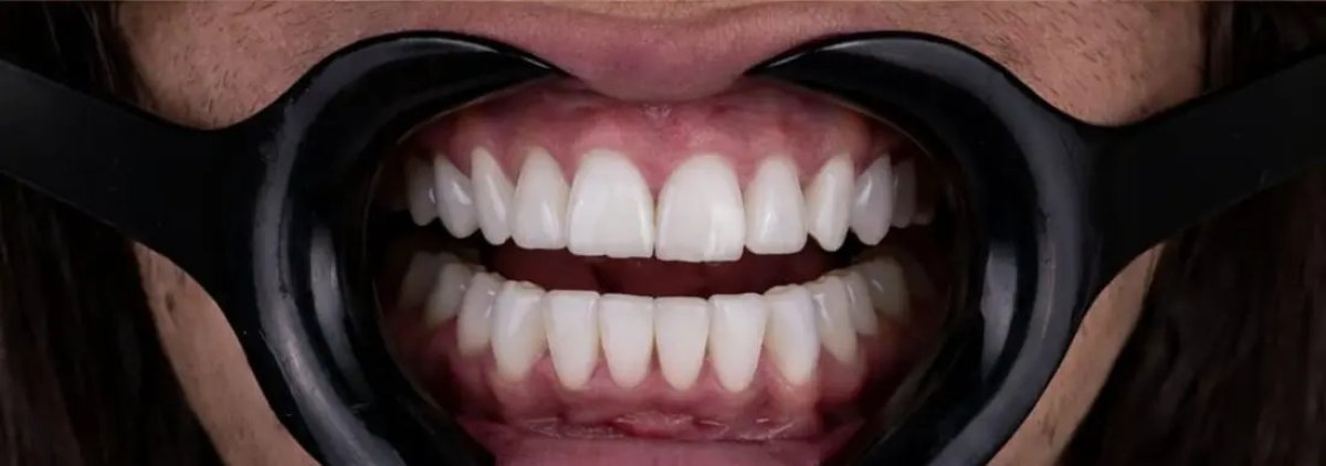 Smile transformation result with dental veneers, even white teeth after veneers procedure