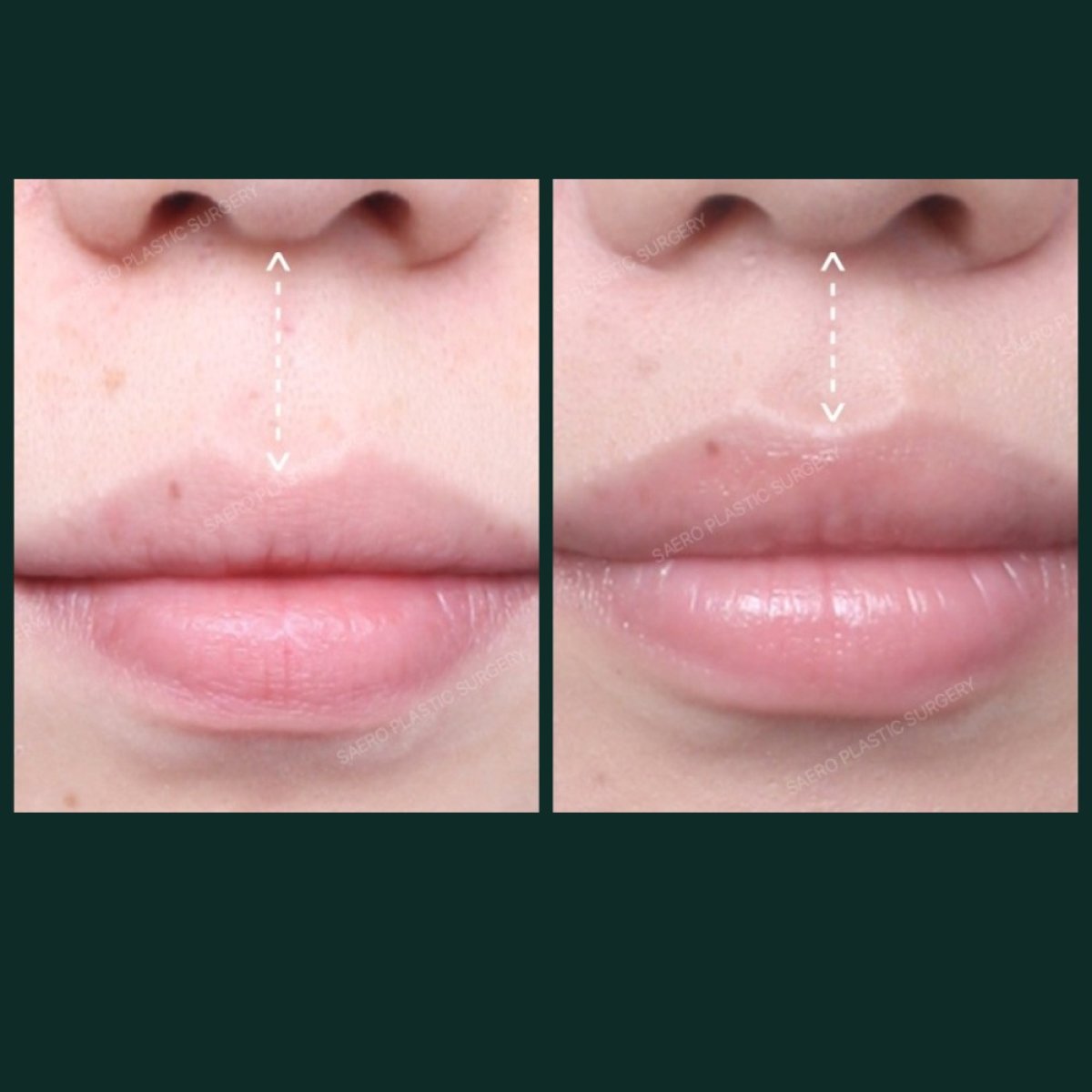 Before and after lip lift results at SAERO Plastic Surgery – enhanced upper lip contour