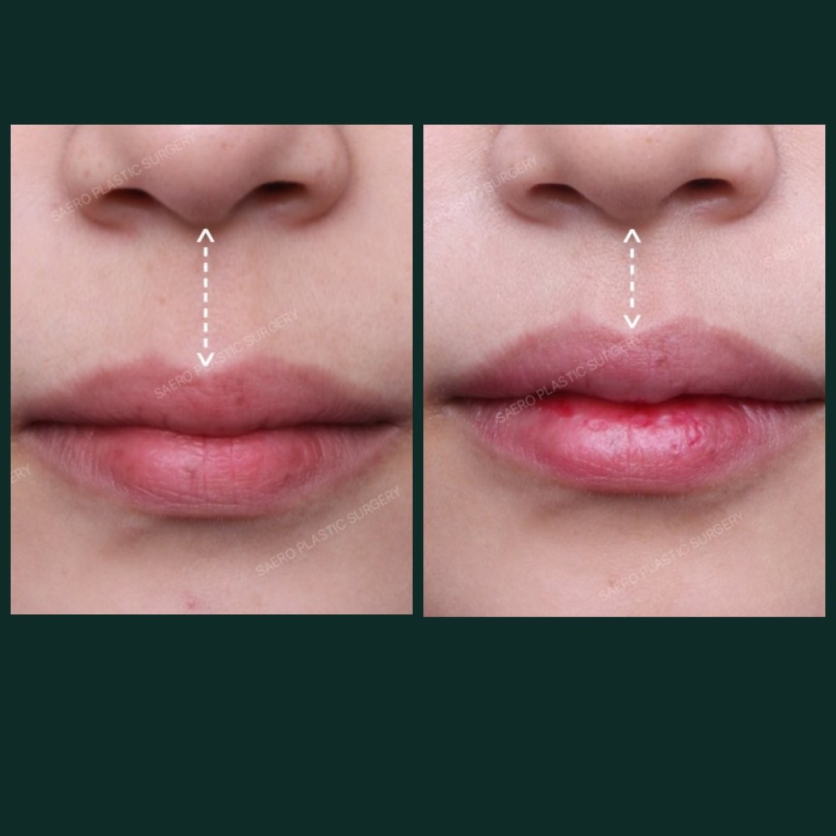 Before and after lip lift results at SAERO Plastic Surgery – enhanced upper lip contour