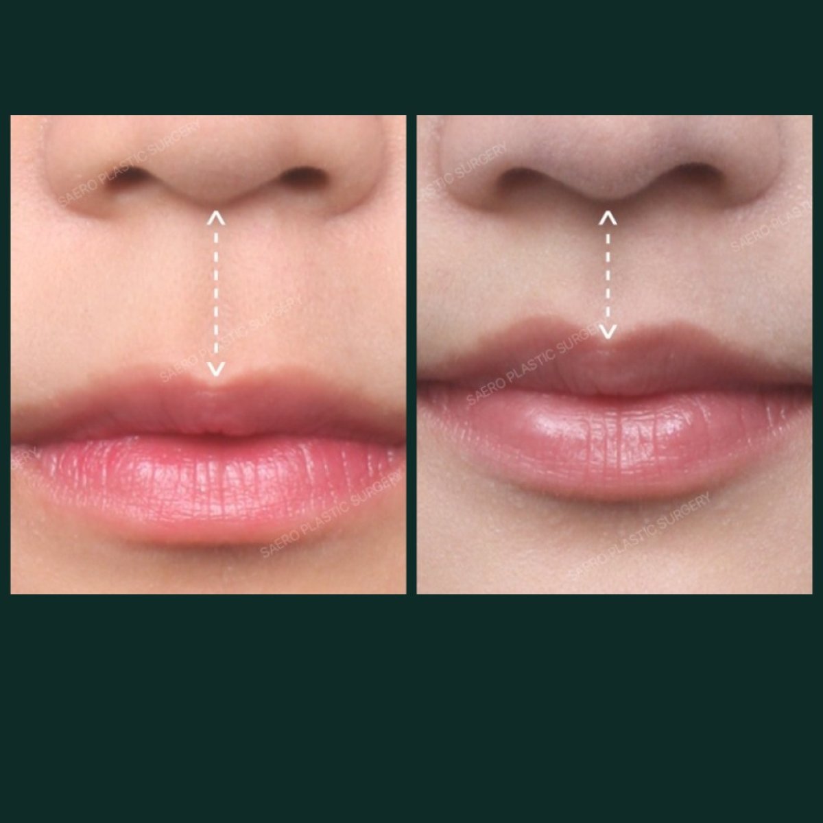 Resultados de lifting de labios antes y después en SAERO Plastic Surgery, contorno mejorado