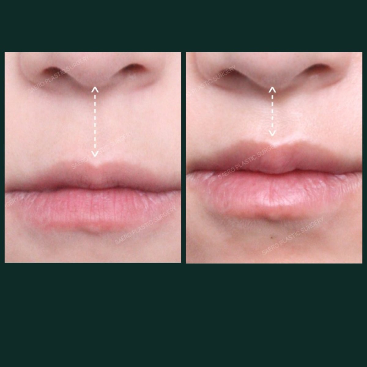 Resultados antes y después de lip lift en SAERO Plastic Surgery, contorno labial mejorado