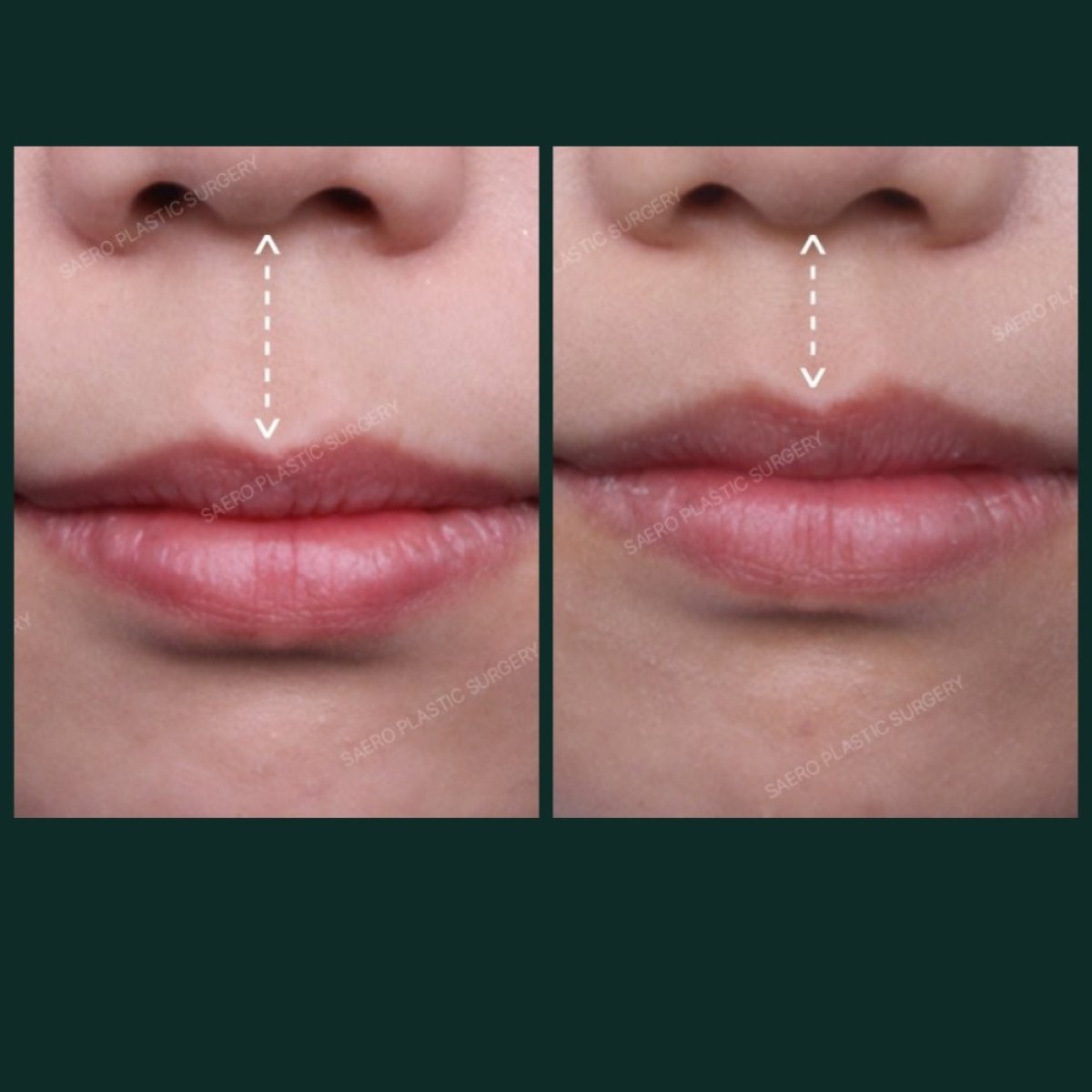 Resultados de antes y después de lip lift en SAERO Plastic Surgery, mejor contorno labial