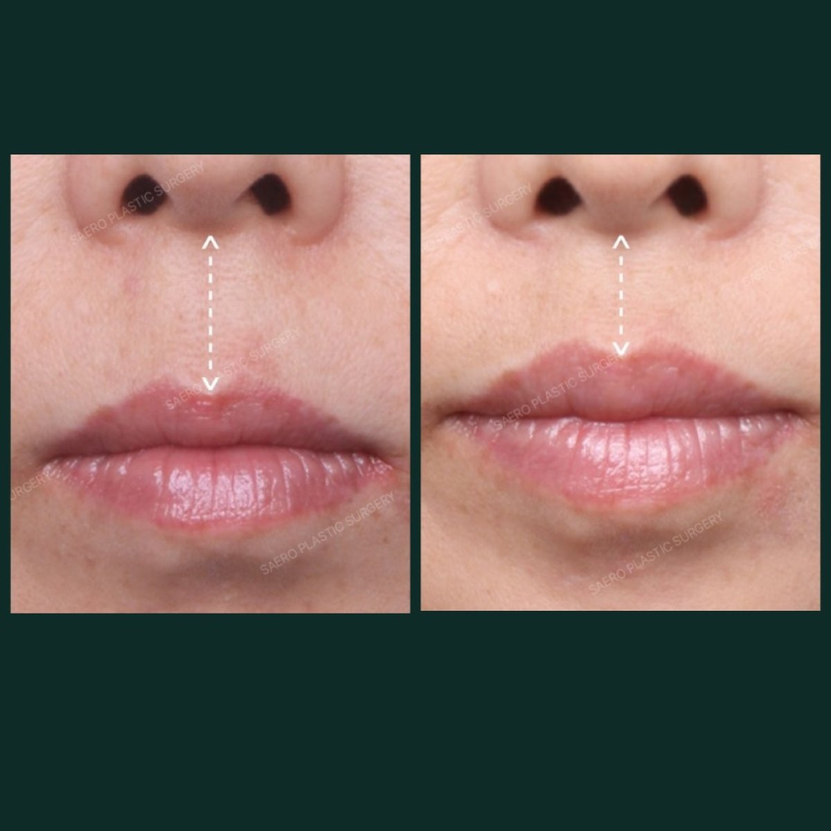 Resultados de lip lift antes y después en SAERO Plastic Surgery – contorno labial mejorado