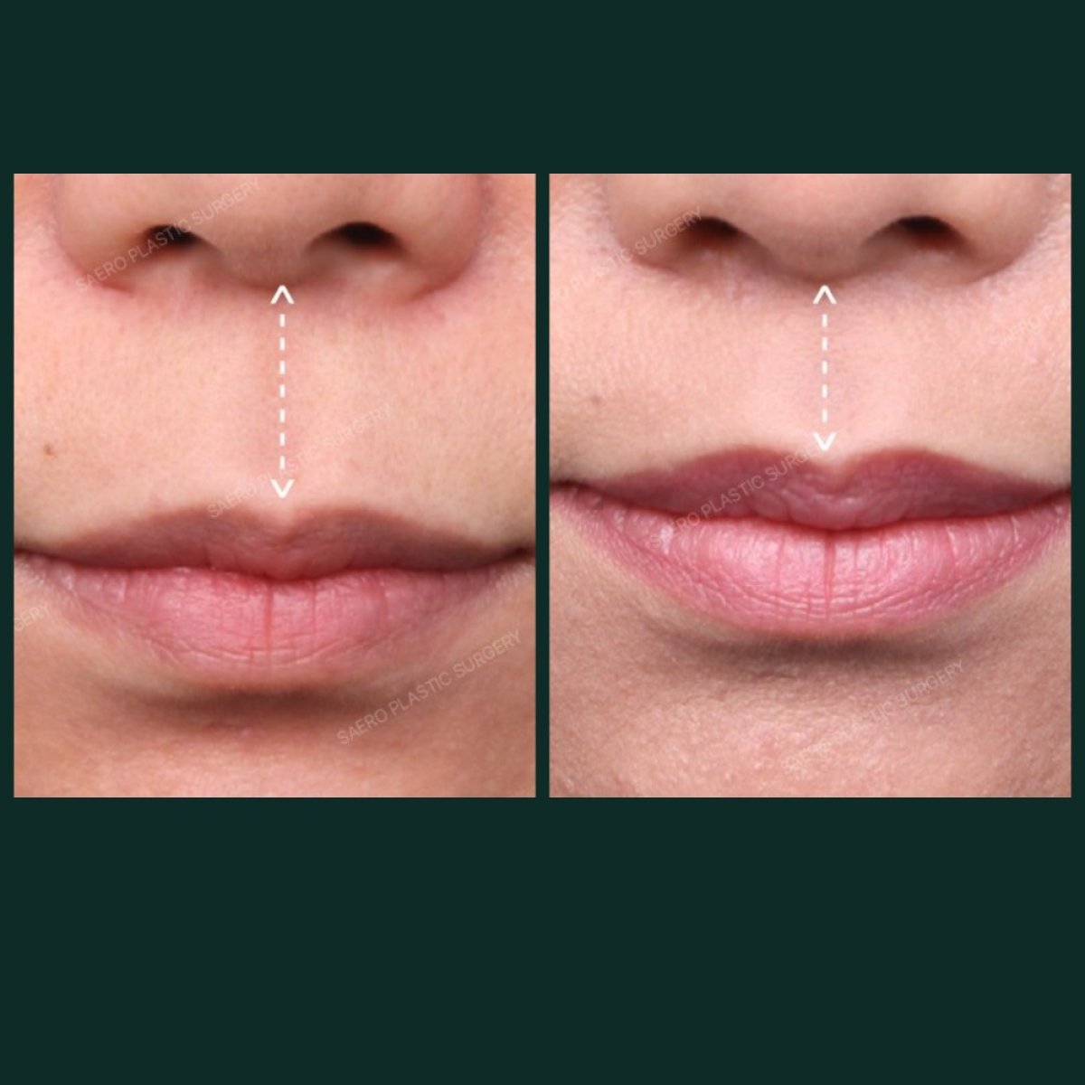 Результати до і після ліп ліфтингу в SAERO Plastic Surgery, покращений контур губ