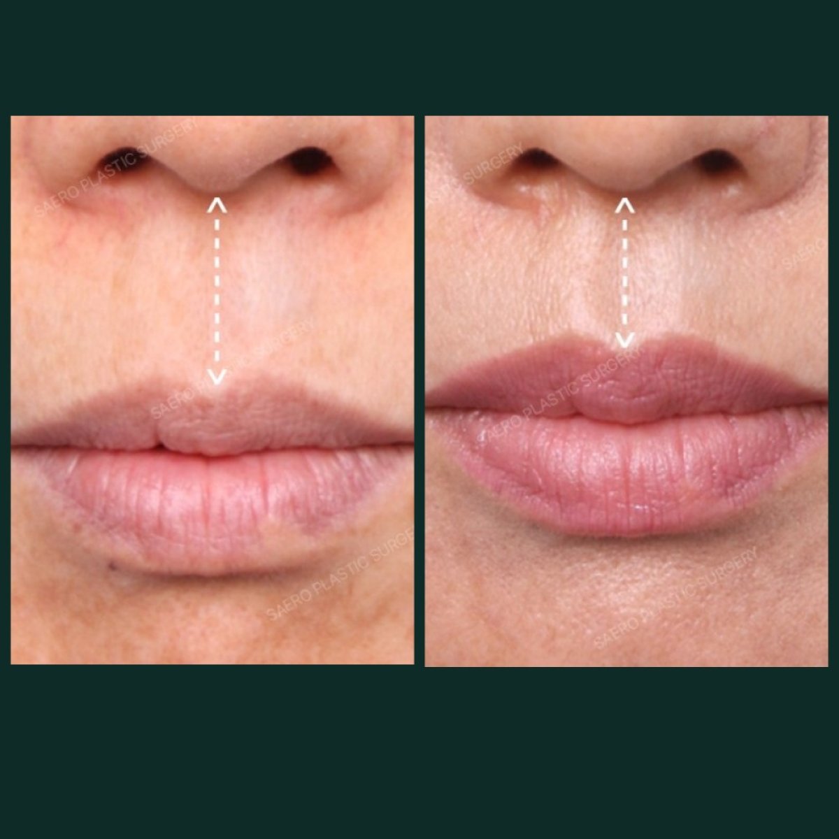 Before and after lip lift results at SAERO Plastic Surgery – enhanced upper lip contour