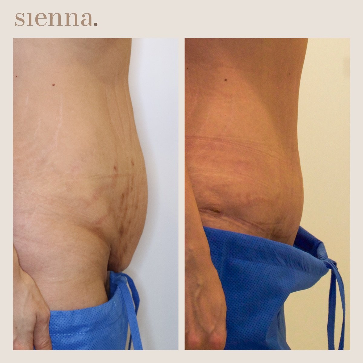 Before and after abdominal liposuction results at Sienna Clinic – slimmer waist contour