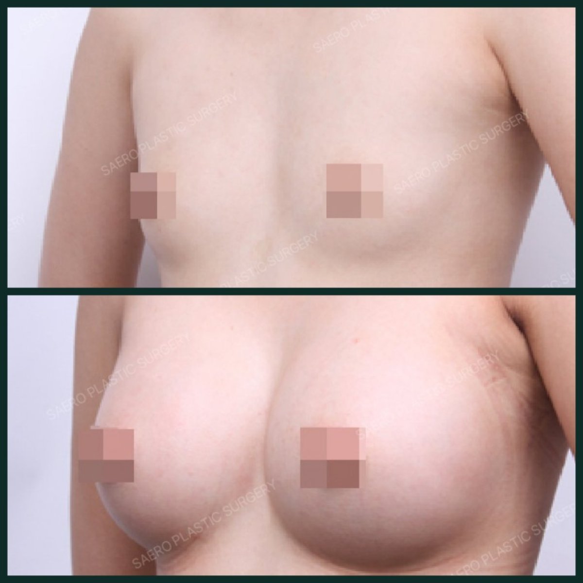 نتائج قبل وبعد تكبير الثدي في SAERO Plastic Surgery، زيادة حجم الثدي