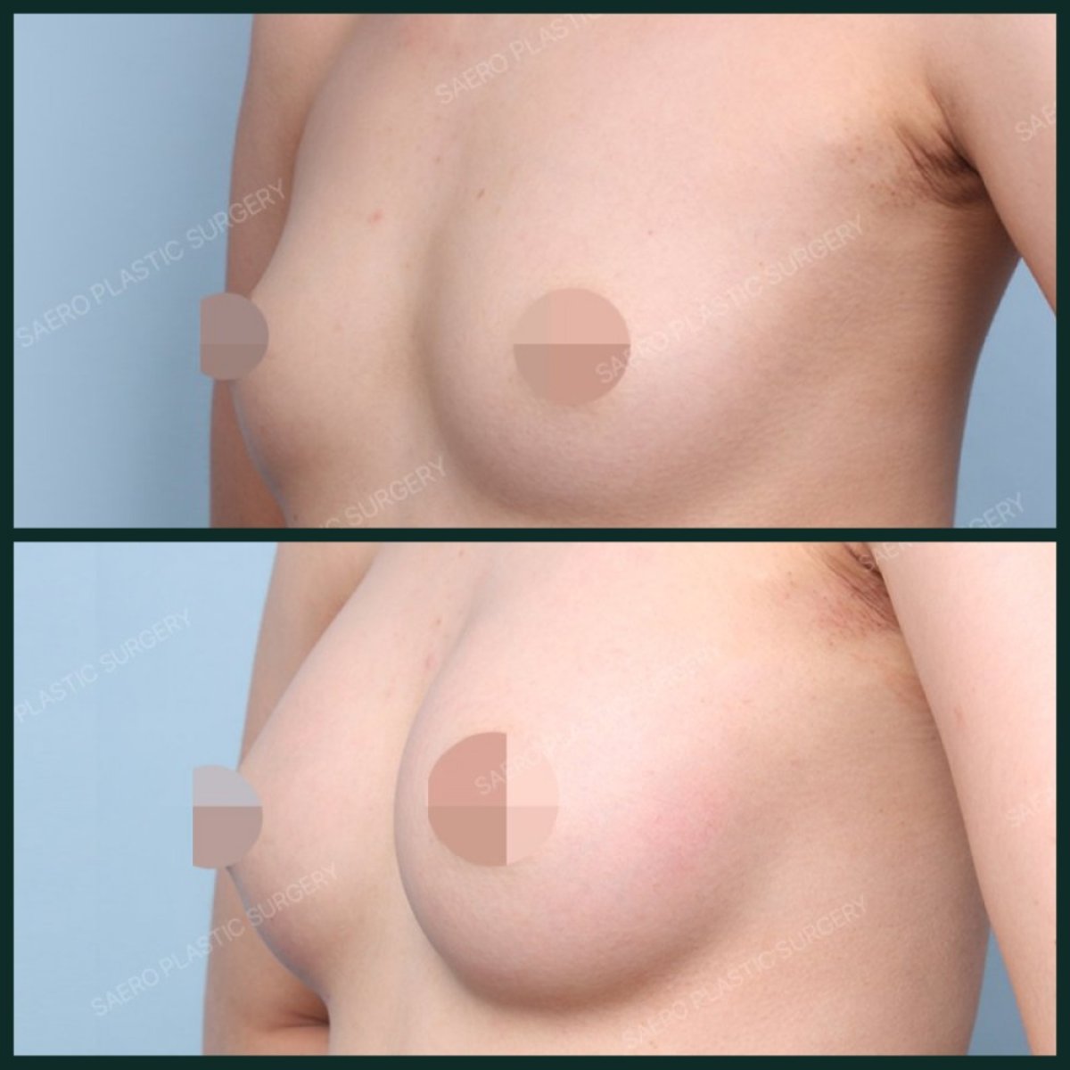 Vorher-nachher Brustvergrößerung bei SAERO Plastic Surgery, sichtbares Volumenergebnis