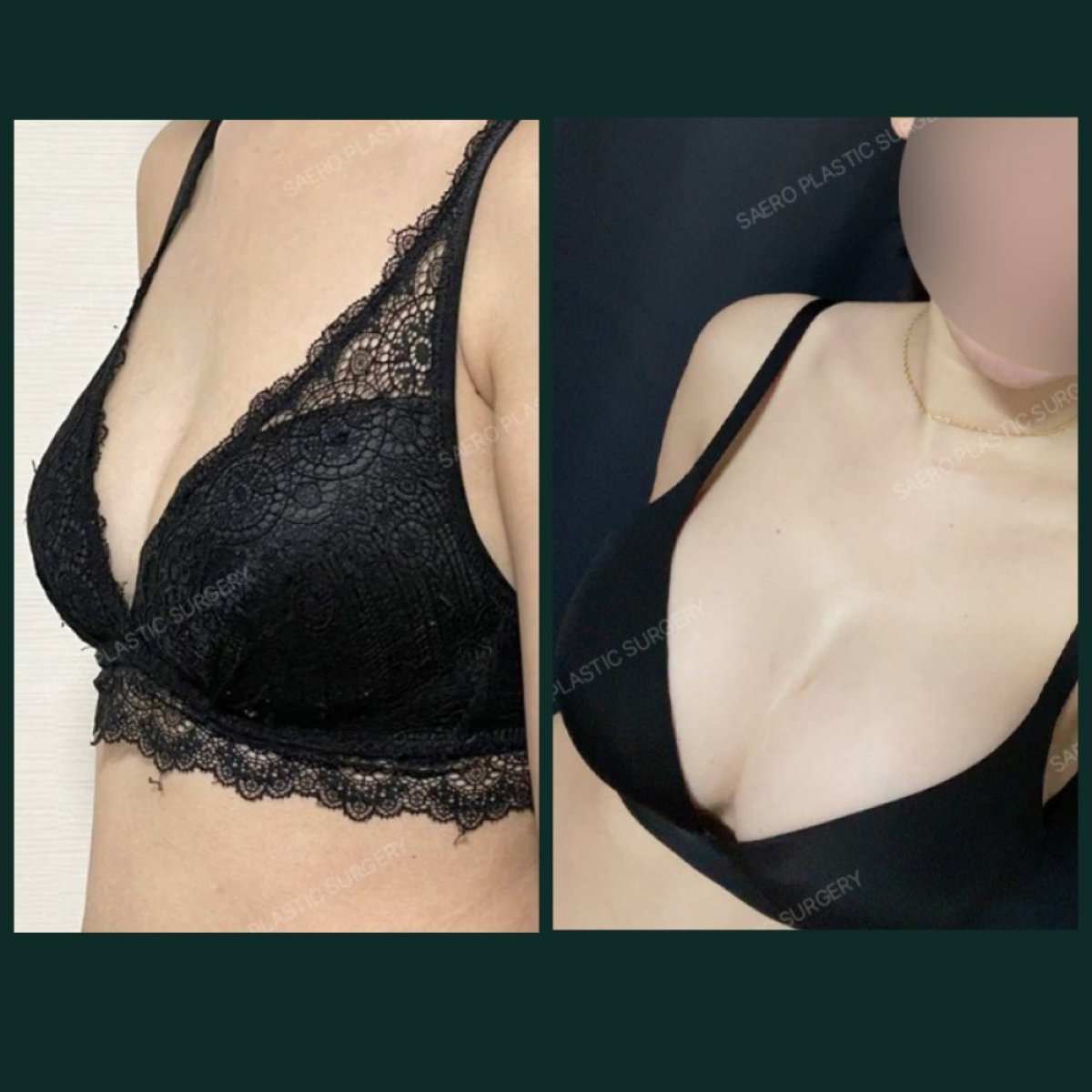 نتائج قبل وبعد تكبير الثدي في SAERO Plastic Surgery، تحسين شكل الثدي