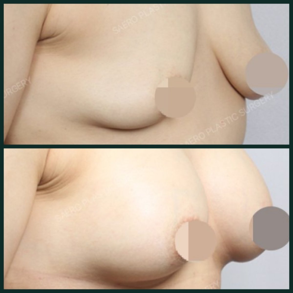 Resultados antes y después de aumento de senos en SAERO Plastic Surgery, mayor volumen mamario