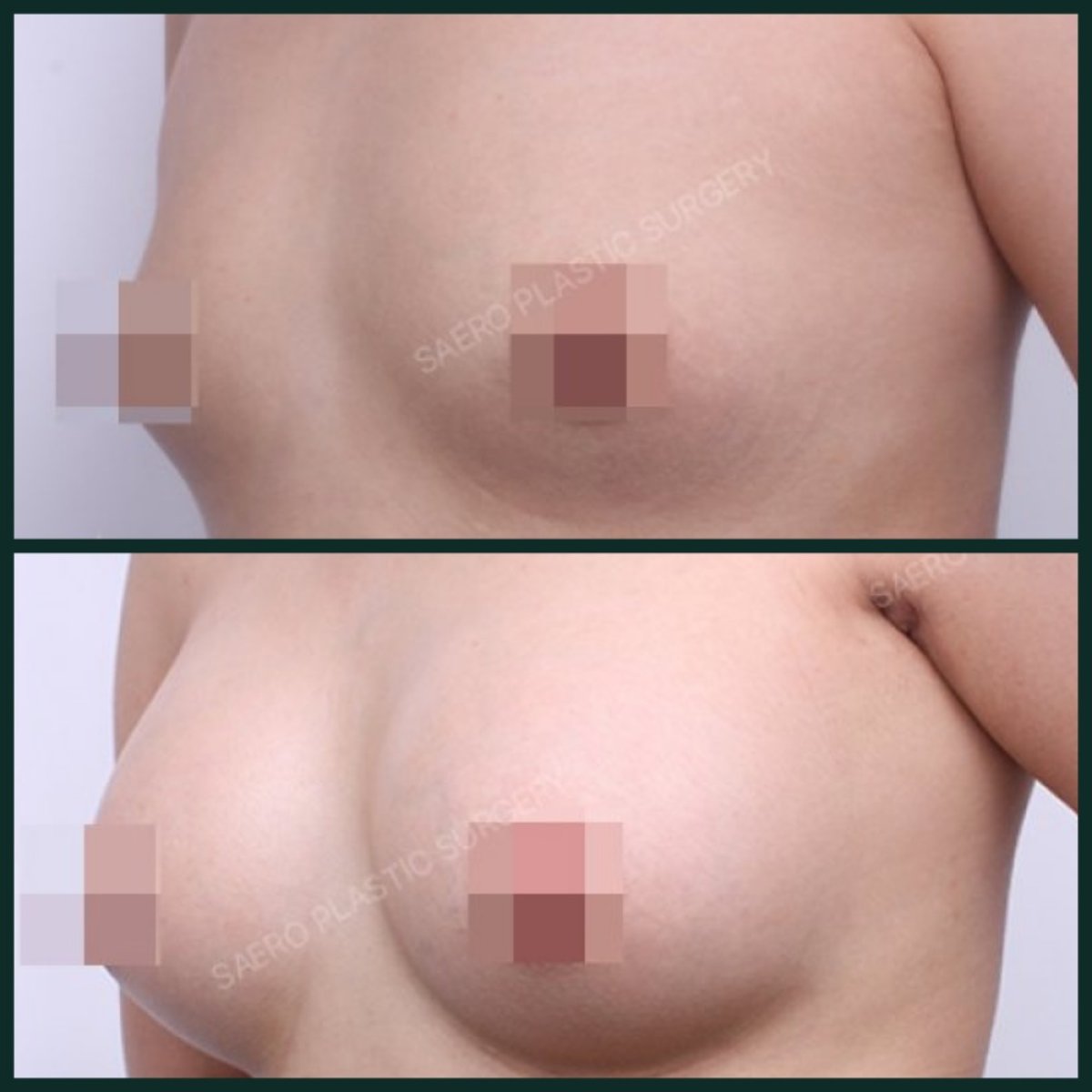 Результаты до и после увеличения груди в SAERO Plastic Surgery, увеличенный объем груди
