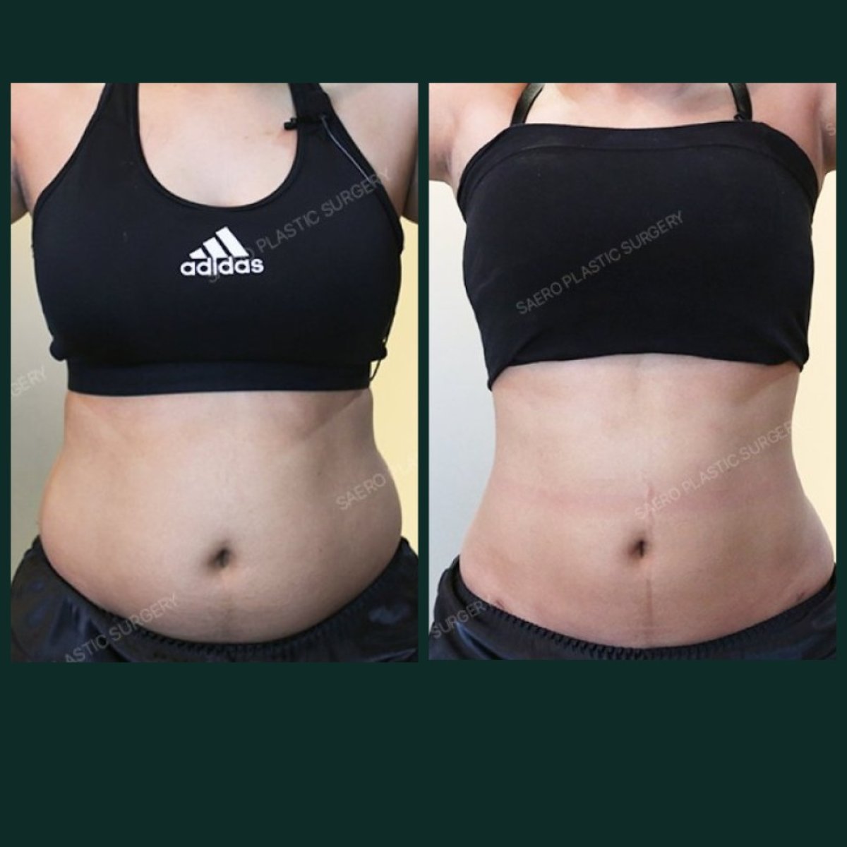 Résultats avant/après abdominoplastie chez SAERO Plastic Surgery – ventre plat