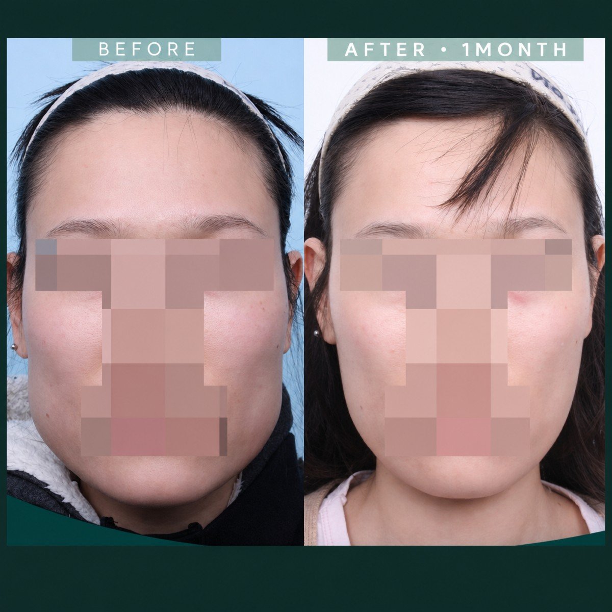 قبل وبعد تصغير عظم الوجنة في SAERO Plastic Surgery، نتيجة تحديد الوجه النحيف