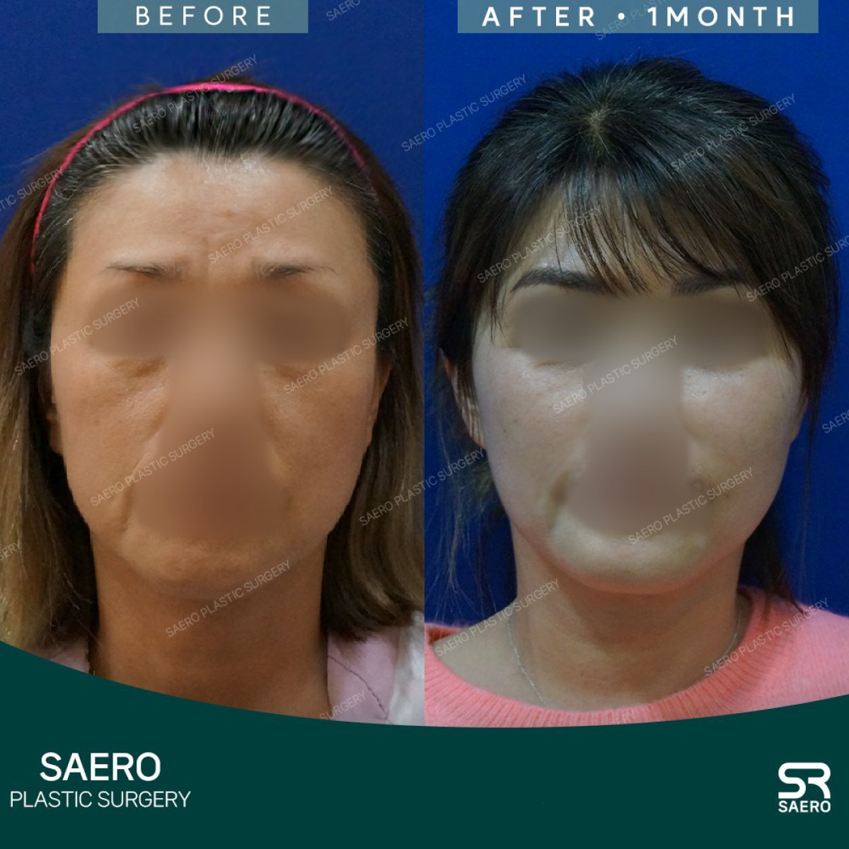 Контуринг лінії щелепи до і після в SAERO Plastic Surgery, покращене окреслення обличчя