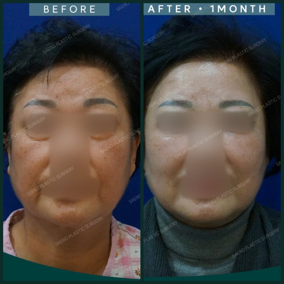 Resultados de contorno de mandíbula antes y después en SAERO Plastic Surgery, rostro definido