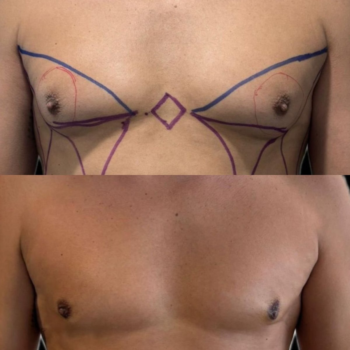 Resultado antes y después de ginecomastia en Lucio Santos Plastic Surgery, contorno masculino