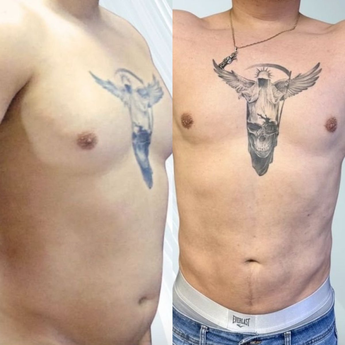 Результати до і після операції гінекомастії в Lucio Santos Plastic Surgery, плоскі груди