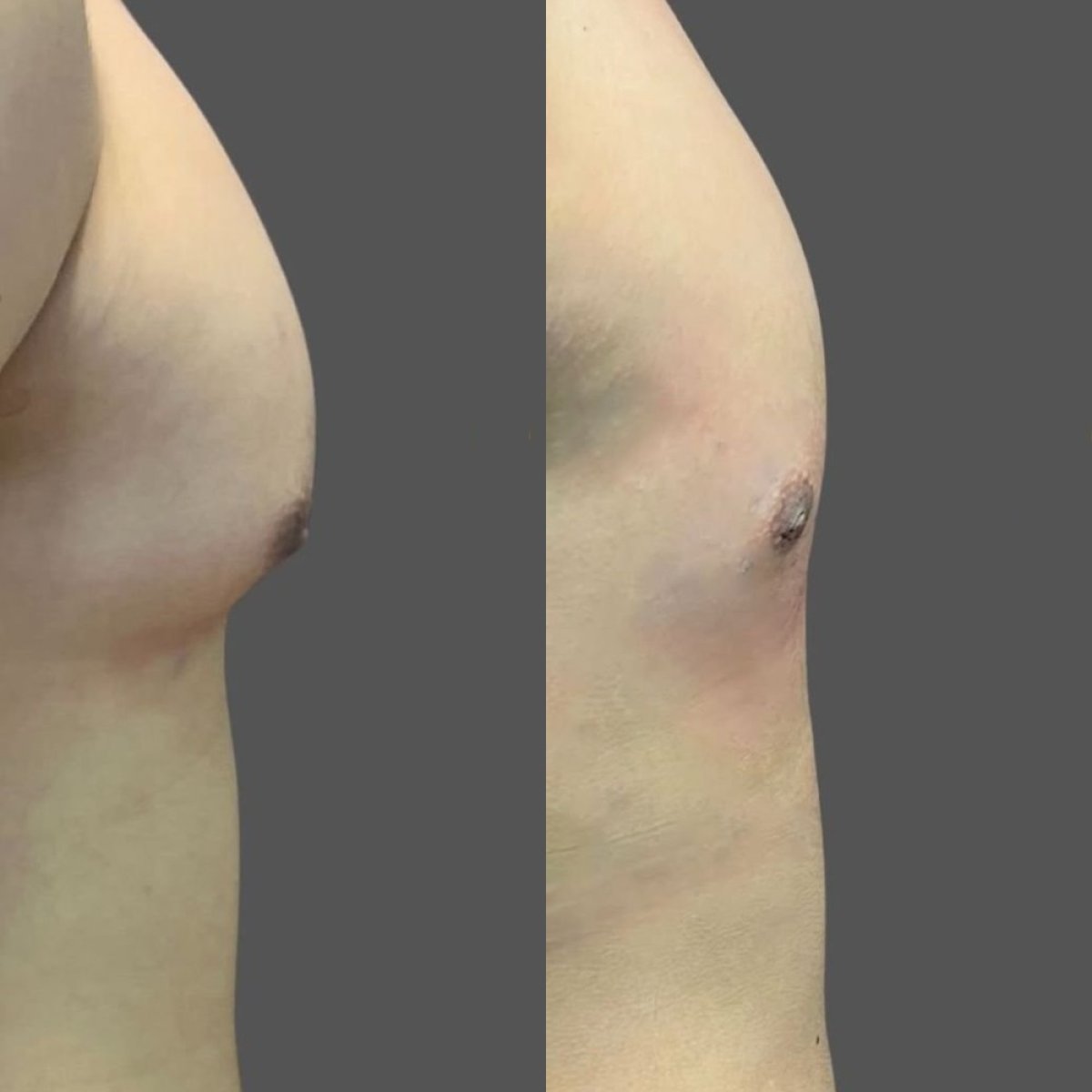 Resultados antes y después de cirugía de ginecomastia en Lucio Santos Plastic Surgery, contorno de pecho