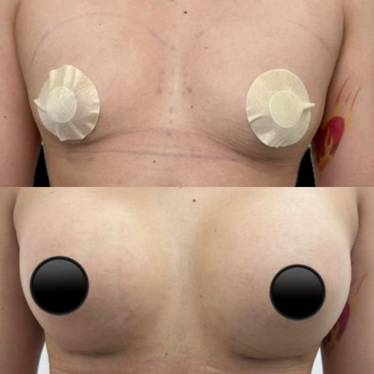 Antes y después de aumento de senos en Lucio Santos Plastic Surgery, resultado de mayor volumen
