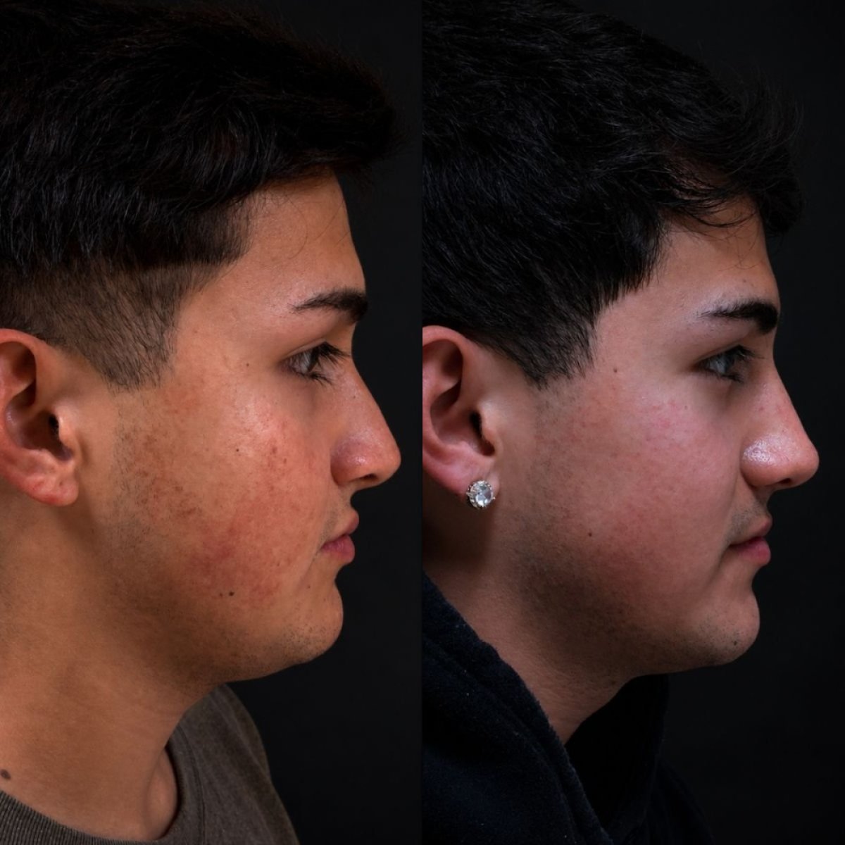 Résultat avant-après rhinoplastie chez Lucio Santos Plastic Surgery, profil du nez amélioré