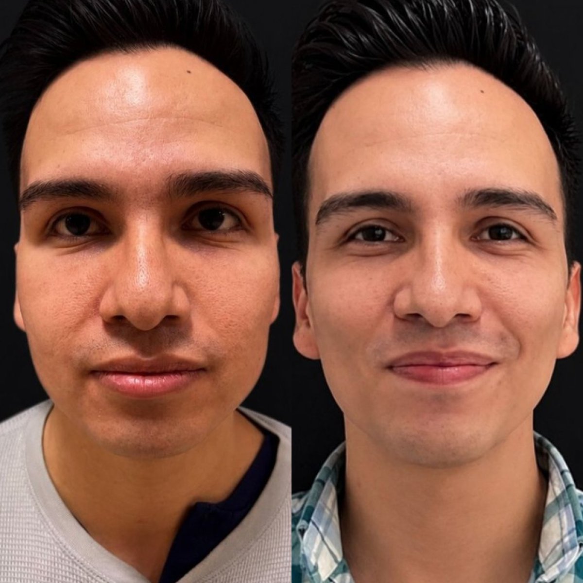قبل وبعد إزالة دهون الخدود في Lucio Santos Plastic Surgery، نتيجة تحديد الوجه النحيف