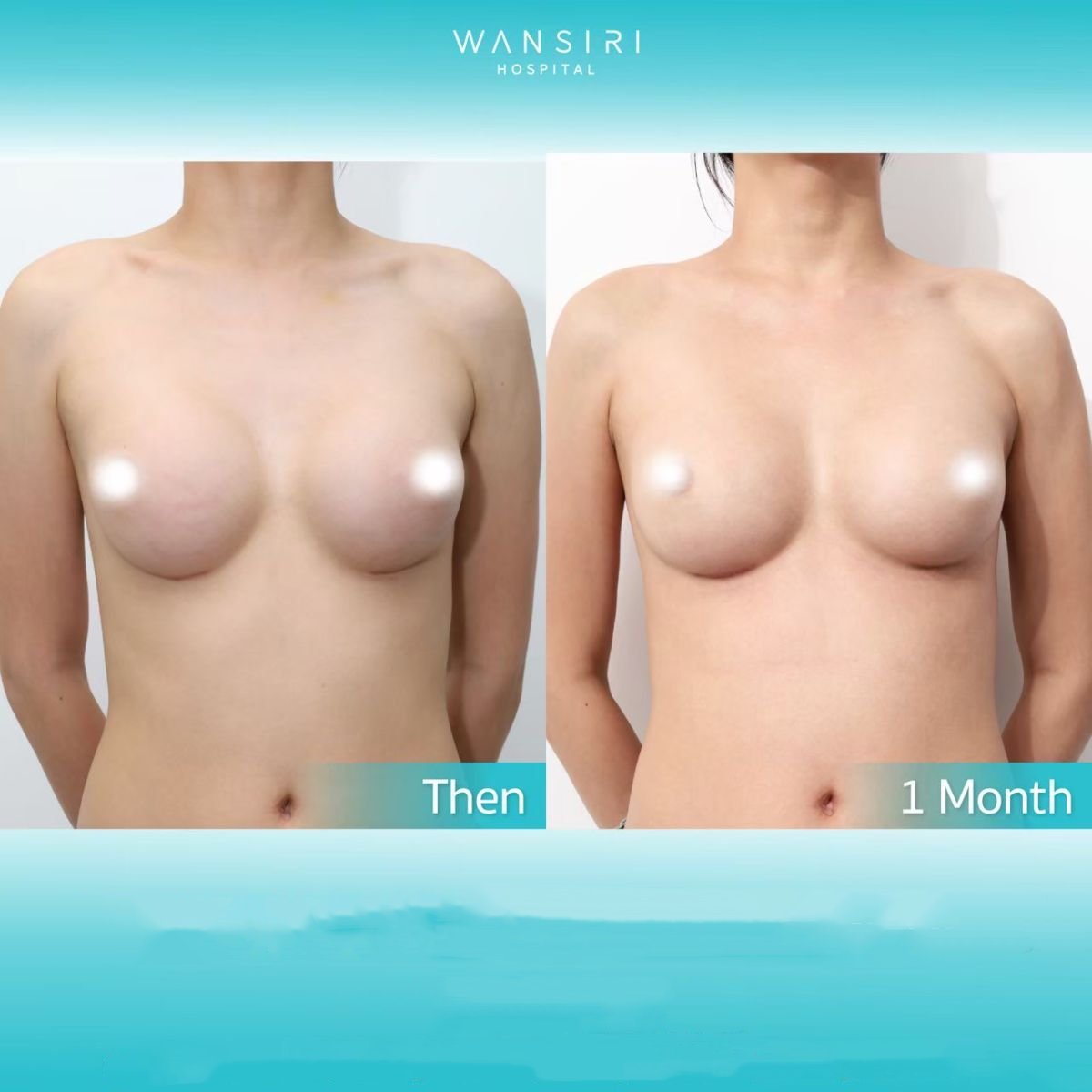 Before and after lipofilling breast augmentation at Wansiri Hospital, natural contour result