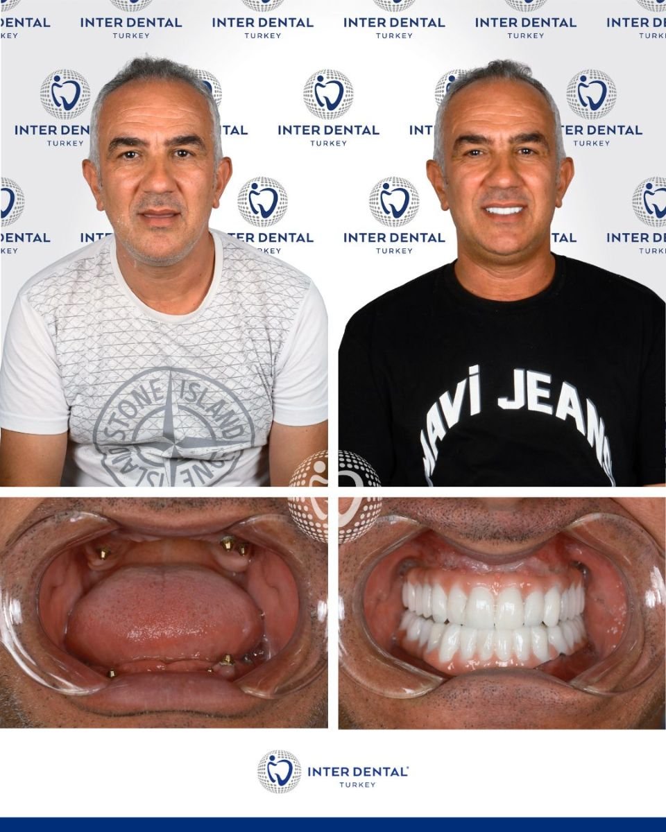 Результаты до и после имплантации зубов в Inter Dental Turkey – полное восстановление улыбки
