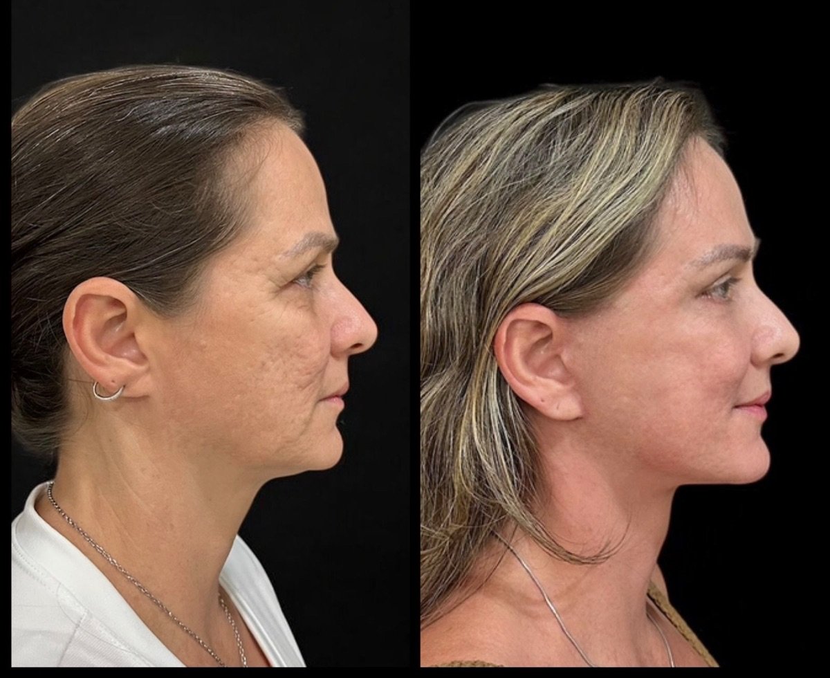 Facelift before and after results at Dr. Michel Salameh - Plastic And Aesthetic Surgery clinic