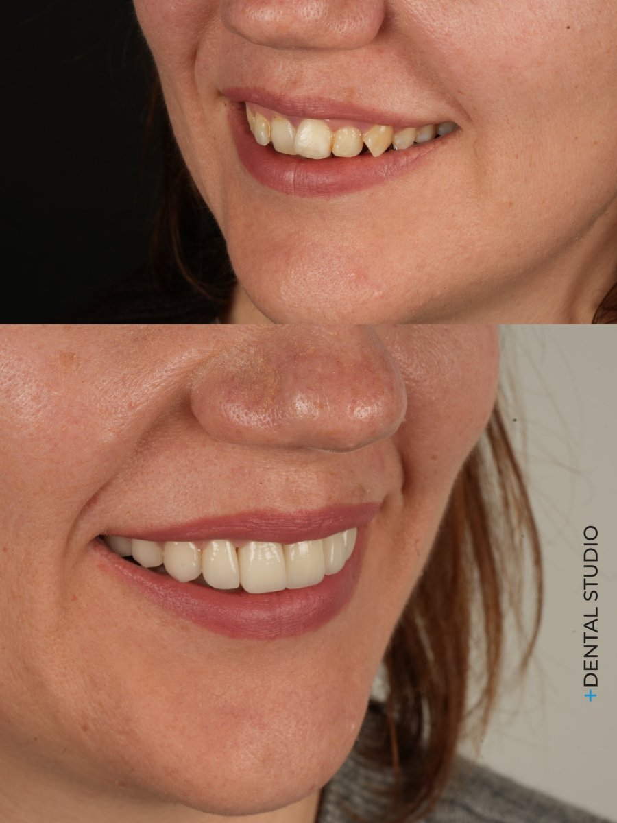 Vorher-nachher-Ergebnis Veneers bei Dental Studio – natürliches Lächeln nach Behandlung