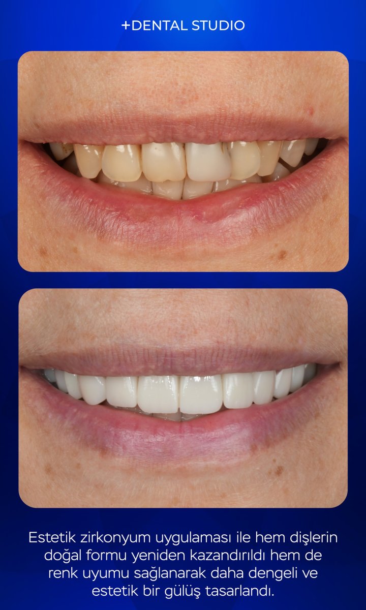 Before and after zirconium crowns at Dental Studio – improved smile aesthetics result