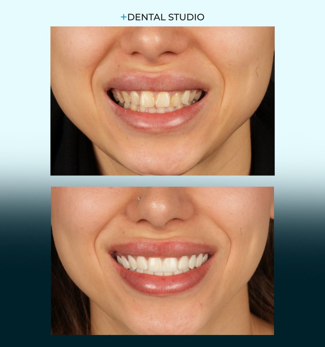 Vorher-nachher-Veneers bei Dental Studio – natürliches Lächeln nach Behandlung