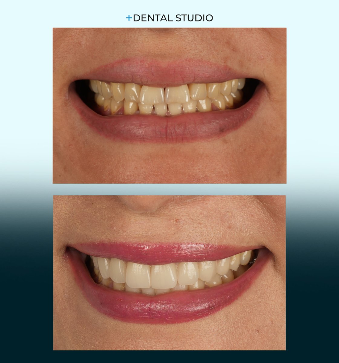 Vorher-nachher-Veneers-Ergebnis bei Dental Studio – schönere, weißere Zähne