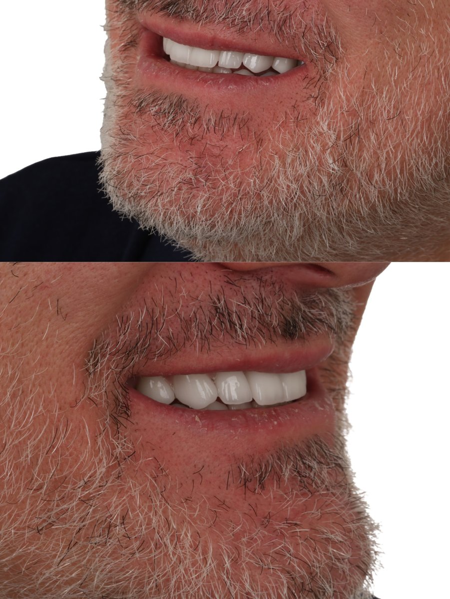 Resultado antes y después de carillas: mejora estética de la sonrisa en paciente masculino